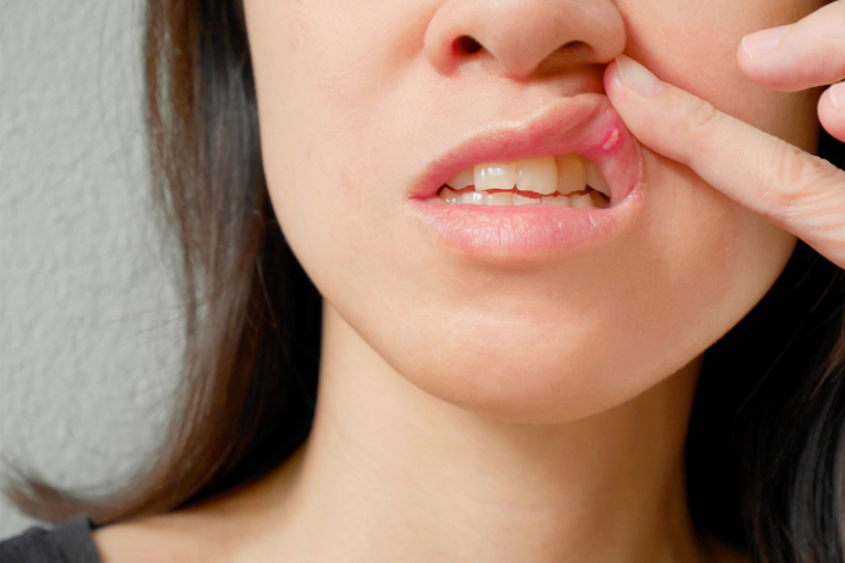 消委會．痱滋/口腔潰瘍｜10款軟膏及啫喱凝膠邊款好？哪款屬處方藥物？｜必知3大選購留意事項