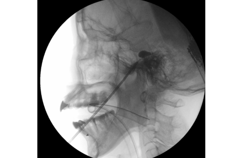 慢性口面部疼痛｜港大醫學院率先引入經皮球囊壓迫術治療頑固性面部疼痛 長期療效驗證：十年緩痛率超七成