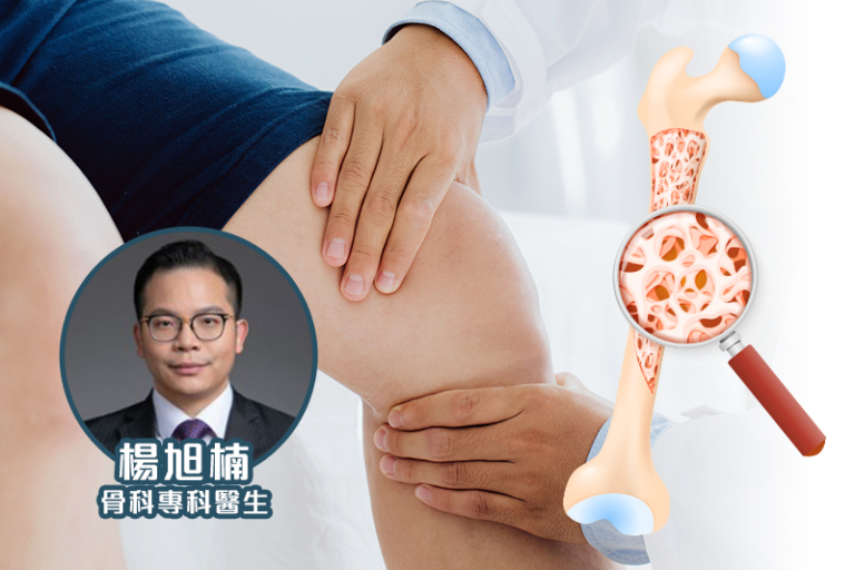 骨質疏鬆治療｜譚玉瑛平日活動自如 一次意外跌傷才驚覺骨質疏鬆｜醫生拆解原因、檢查及治療方法