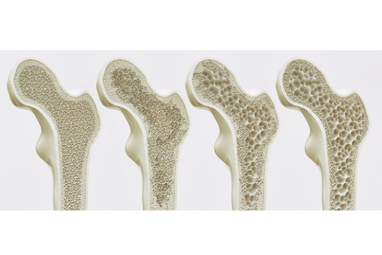 骨質疏鬆治療｜譚玉瑛平日活動自如 一次意外跌傷才驚覺骨質疏鬆｜醫生拆解原因、檢查及治療方法