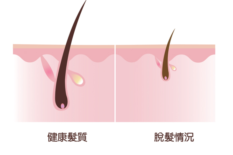 脫髮警號響起：髮線後退？髮界線變闊？解構生髮關鍵！1款育髮營養保健品助你重拾青春濃密秀髮！