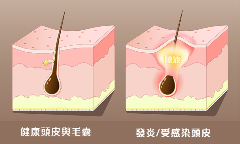 醫生拆解頭瘡形成原因、症狀及治療-張傑醫生-兒科專科