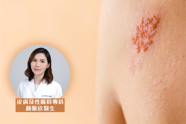 出過水痘易生蛇-帶狀皰疹原因-症狀-黃金治療時間-皮膚及性病科專科顏佩欣醫生