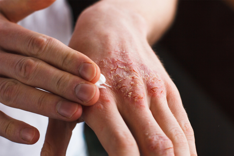 濕疹｜調查發現67%中度至嚴重患者無效花費 近3成花10年以上尋合適治療