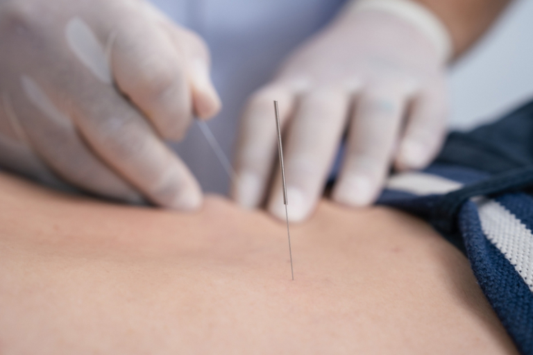 中醫拆解針灸「暈針／暈灸」：成因、常見症狀與預防處理