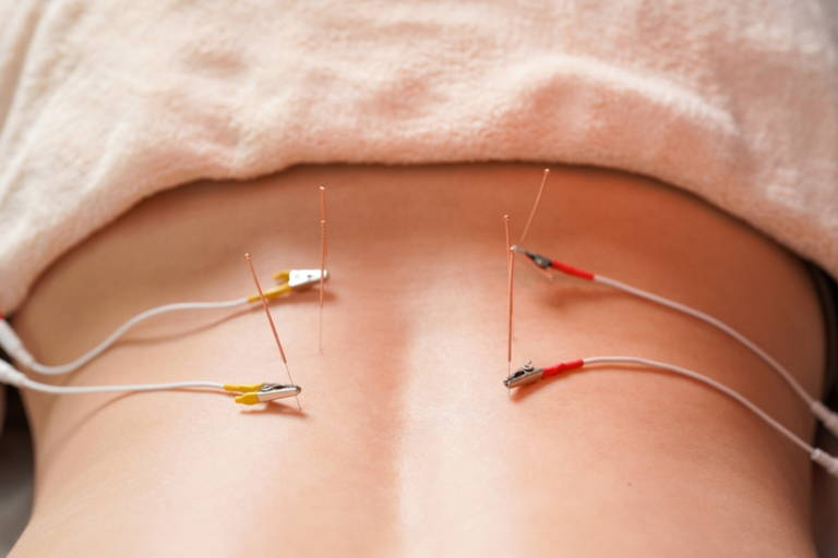 中醫拆解針灸「暈針／暈灸」：成因、常見症狀與預防處理