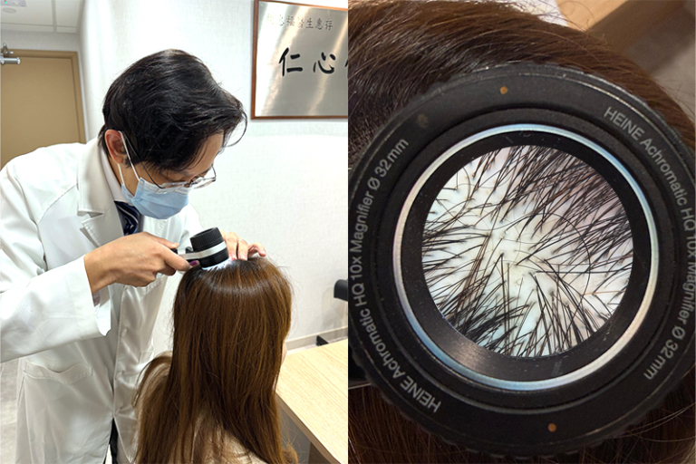 脫髮症狀-正常髮量-掉髮改善-最年輕脫髮病例僅16歲-生髮療程有用-皮膚科醫生破解掉髮治療迷思