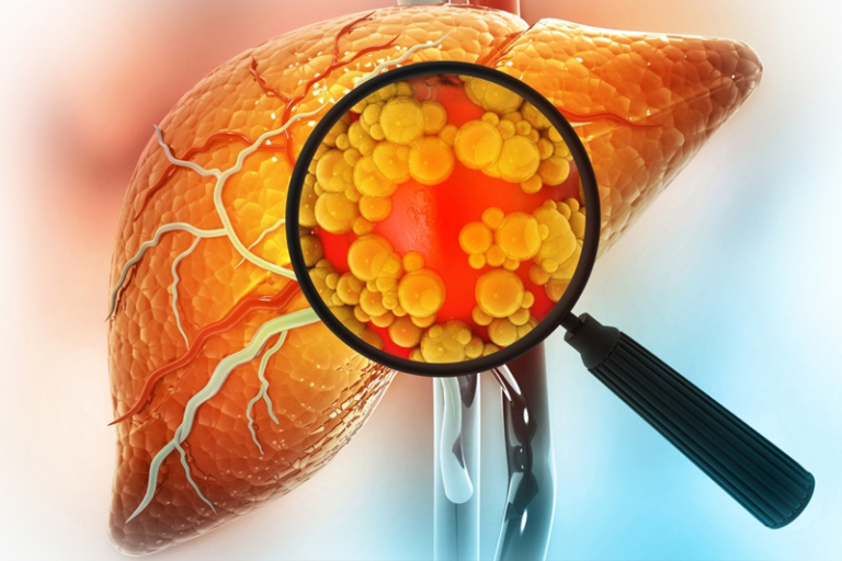 肝細胞癌是全球第六常見的癌症，亦是第三大癌症死亡原因。隨着肥胖、糖尿病和代謝綜合症日益普遍，由代謝失調引起的脂肪肝及脂肪性肝炎已成為主要的肝癌成因。港大醫學院臨床醫學學院病理學系及肝病研究全國重點實驗室的研究團隊發現，一款已獲美國食品及藥物管理局（FDA）批准、用於治療代謝失調相關脂肪性肝病的新藥Resmetirom，不僅能減少肝臟脂肪及纖維化，更有潛力預防及抑制由脂肪肝引致的肝癌。