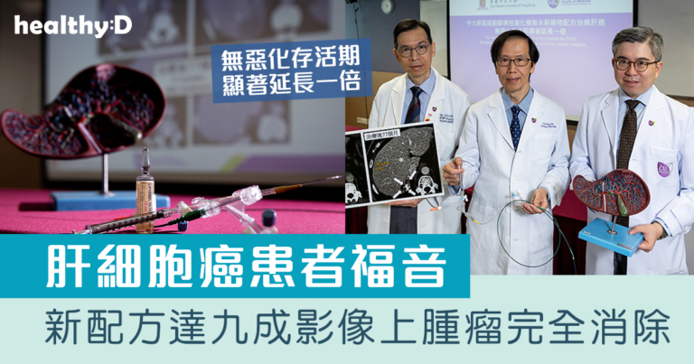 肝癌治療｜中大研發經動脈碘栓塞化療無水新藥物配方治療肝細胞癌 無惡化存活期顯著延長一倍