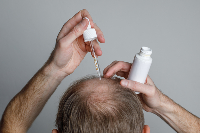 脫髮症狀-正常髮量-掉髮改善-最年輕脫髮病例僅16歲-生髮療程有用-皮膚科醫生破解掉髮治療迷思