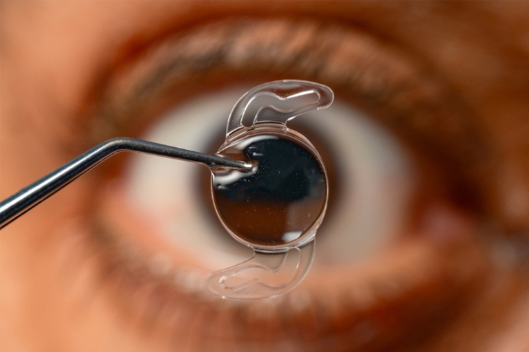 白內障晶體選擇2026｜4款人工晶體點揀好？推介1間旗艦眼科中心 逾30年眼科服務經驗