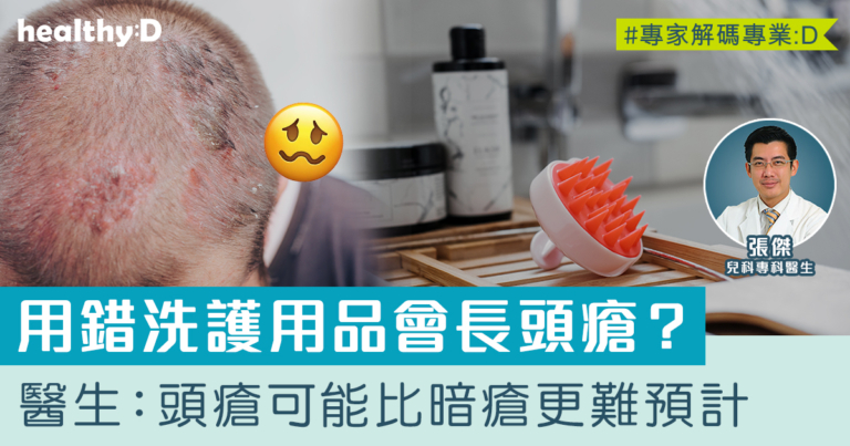 頭瘡可能比暗瘡更難預計！醫生拆解頭瘡形成原因、症狀及治療