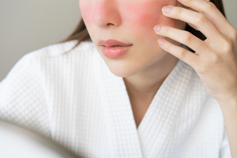 玫瑰痤瘡治療｜35歲女律師臉部飽受紅斑困擾 情緒焦慮加重病情｜西醫精準藥物+中醫辨證調養 助復發風險降逾七成