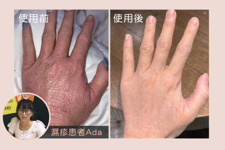 anitch-濕疹護理霜-真實用家分享-濕疹革命性突破-港大廿年科研-濕疹護理新配方-安思靈-打破耐藥性惡性循環-Anitch-高一村教授披露研究後續-冀五年後技術用於治療致命炎症