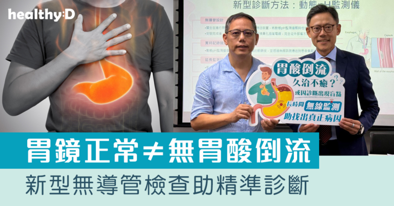 胃酸倒流｜新型無導管檢查 延長監測助精準診斷 配合藥物及手術 改善生活質素