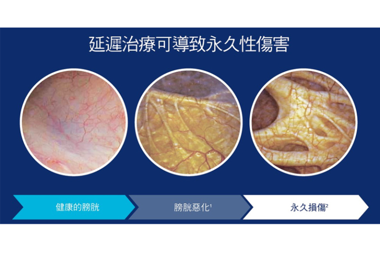 前列腺增生組織拉開就醫好？醫生拆解手術治療新發展：傳統 TURP vs 微創前列腺提拉術