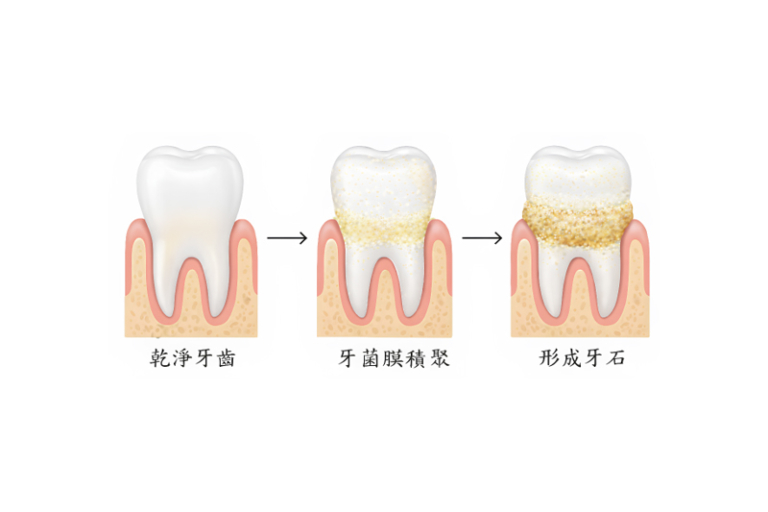 賽馬會幼童健齒計劃