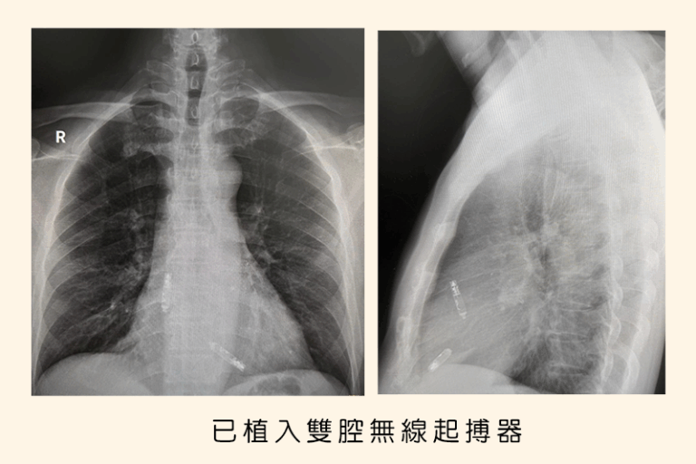 心跳過慢如何治療？傳統有線心臟起搏器 VS無線心臟起搏器優、缺點比較_陳杰醫生 copy