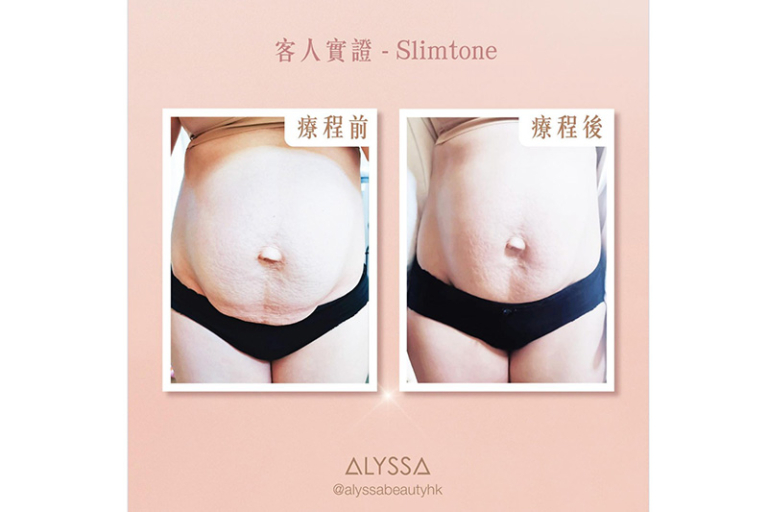 Alyssa Beauty SLIMTONE減肥療程｜醫學實證 全方位 Tone Up身形