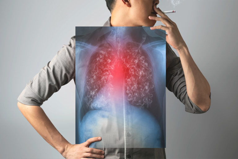 戒煙好處｜及早戒、及早篩：與肺癌賽跑的關鍵一步