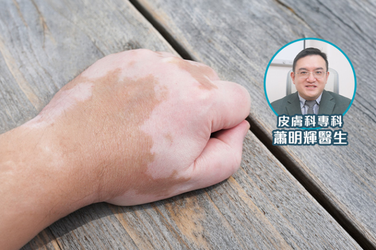 白蝕症狀／類型／治療方法全面睇！醫生解構用藥新選擇——外用JAK抑制劑藥膏