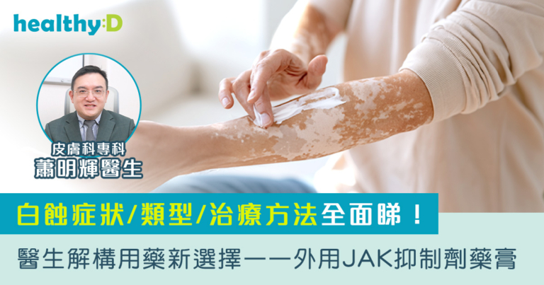 白蝕症狀／類型／治療方法全面睇！醫生解構用藥新選擇——外用JAK抑制劑藥膏