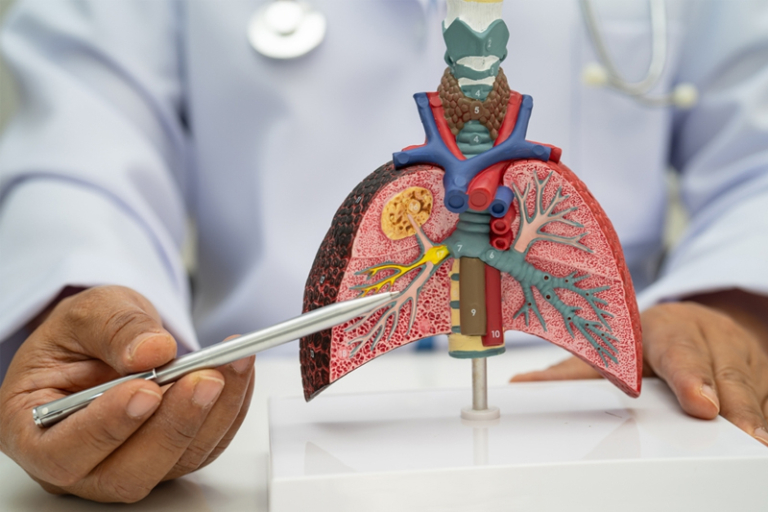 HER2基因突變肺癌患者分享： 盼望留港接受合適的治療｜機構倡政府加快納入藥物名冊 助患者及早受惠