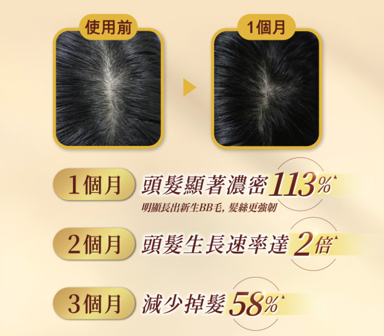 防掉髮保健品分性別更有效？即睇3個真實個案及中醫分析：選女士專用天然配方 逆轉秀髮更豐盈年輕