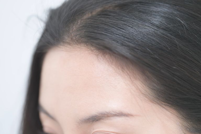 防掉髮保健品分性別更有效？即睇3個真實個案及中醫分析：選女士專用天然配方 逆轉秀髮更豐盈年輕