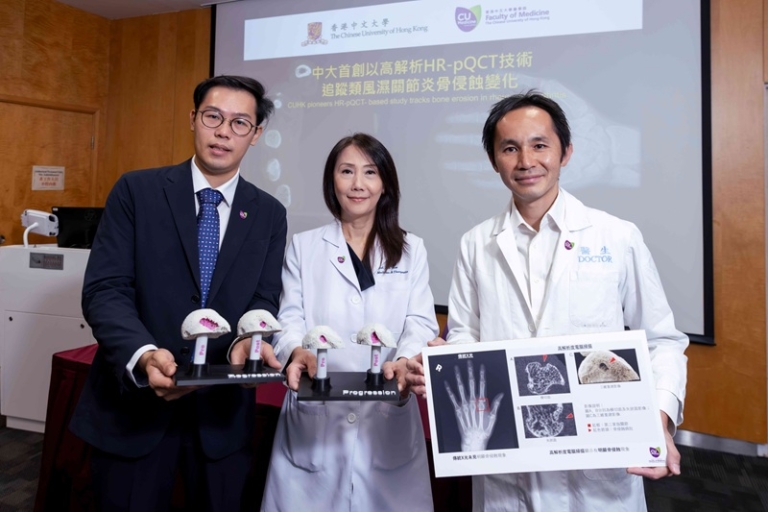 中大首創高解析HR-pQCT技術追蹤類風濕關節炎骨侵蝕變化 準確分辨微小真正病變 倡早診早治逆轉關節損傷