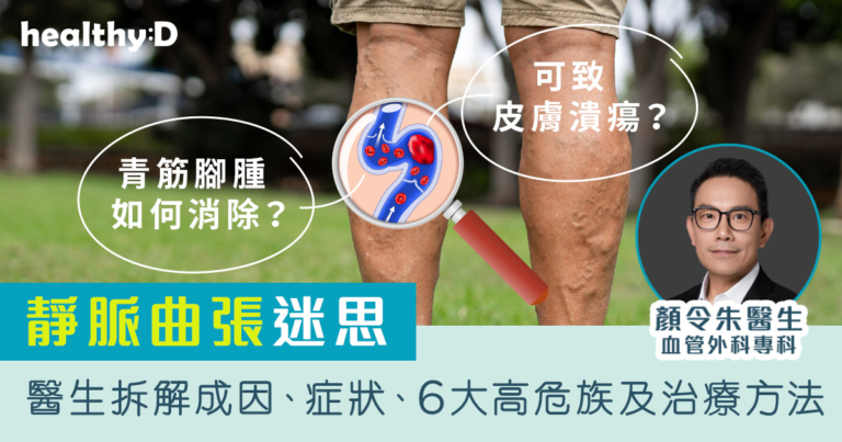 靜脈曲張迷思｜腳青筋如何消除？嚴重可致皮膚潰瘍？醫生拆解成因、症狀、6大高危族及治療方法