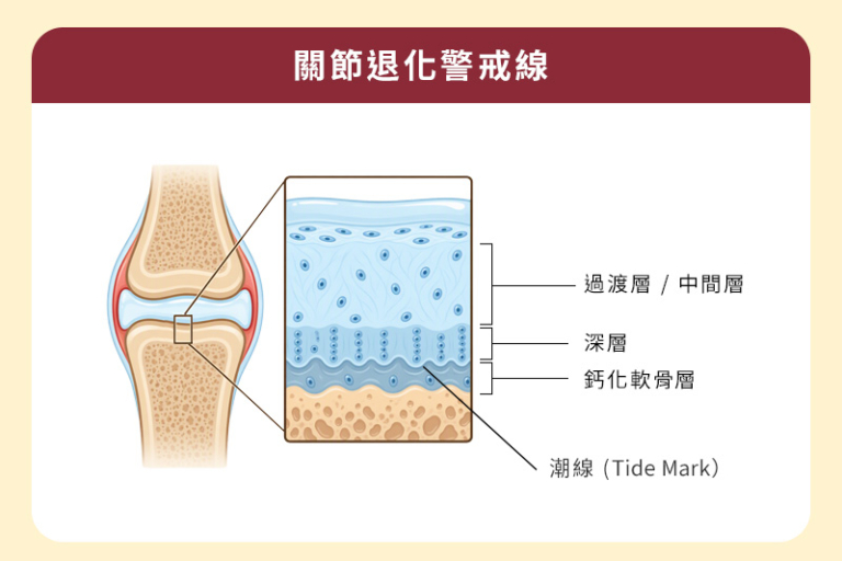 做運動或上落樓梯時聽到膝頭「咔咔聲」? 每2個人就有接近1個會有膝關節不適的困擾 關節退化年輕化 骨科專科醫生提醒勿掉以輕心_圖_3